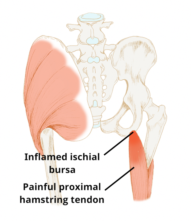 Ischial (sitting bone) bursitis pain | Circle Integrated Care