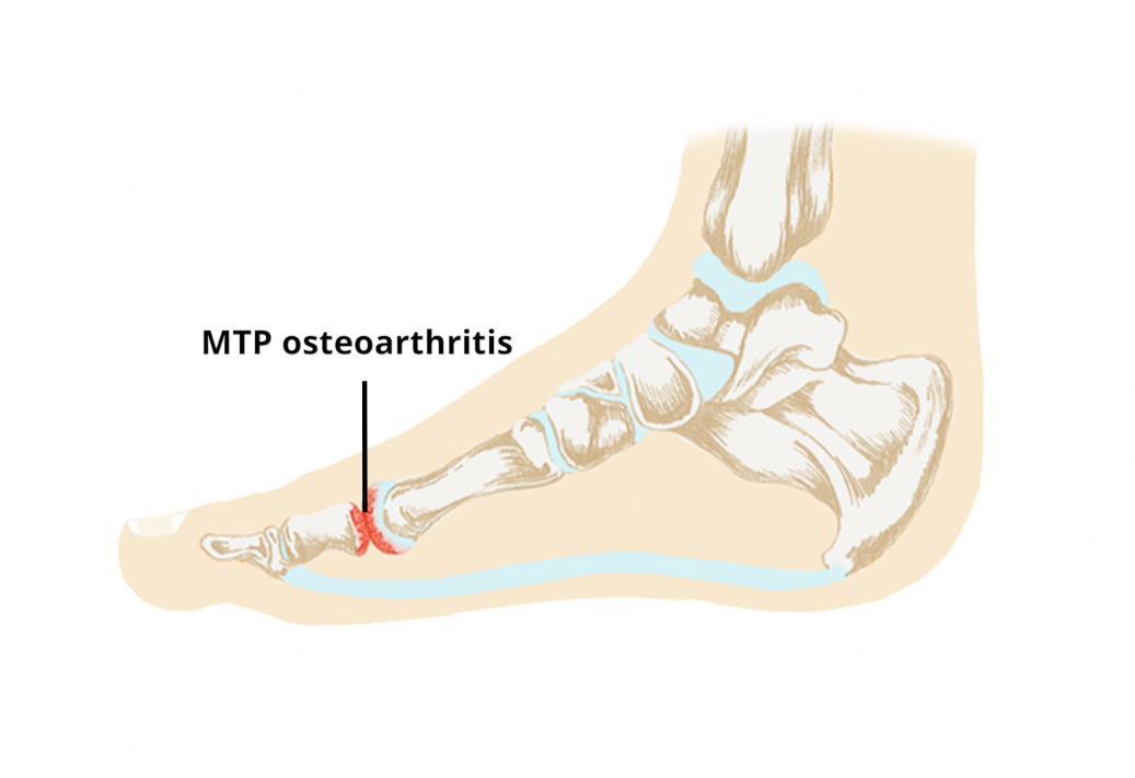metatarsalis arthrosis